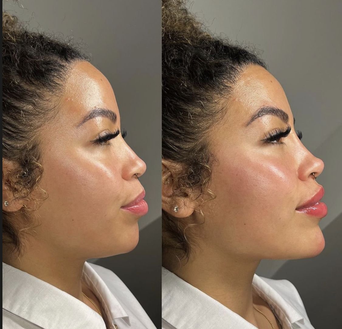 1 ml cheek filler before and after showing natural volume restoration and facial contouring results