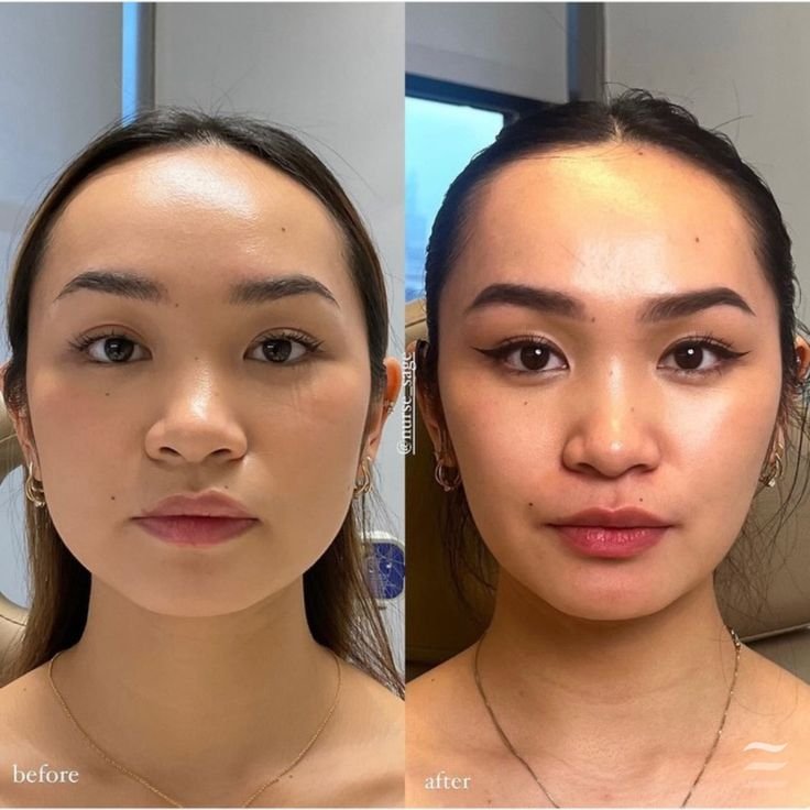 Woman receiving masseter Botox injection for jaw slimming and non-surgical facial contouring