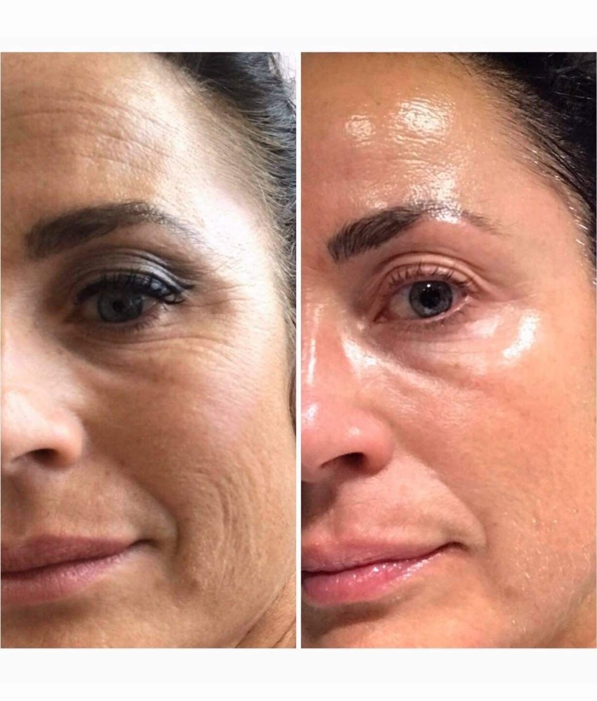 zornesfalte botox
