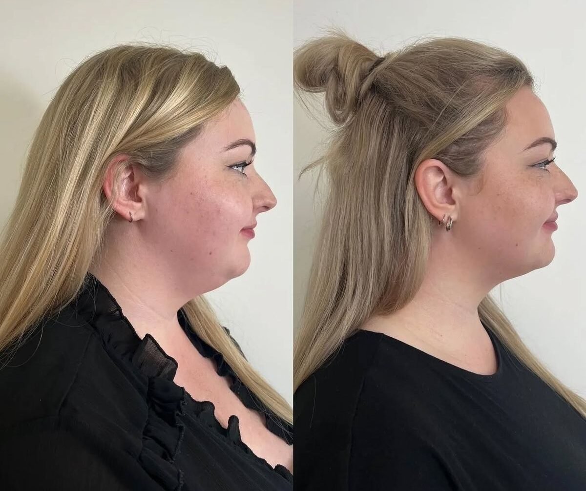 Close-up of a woman with a defined chin and jawline after chin filler treatment