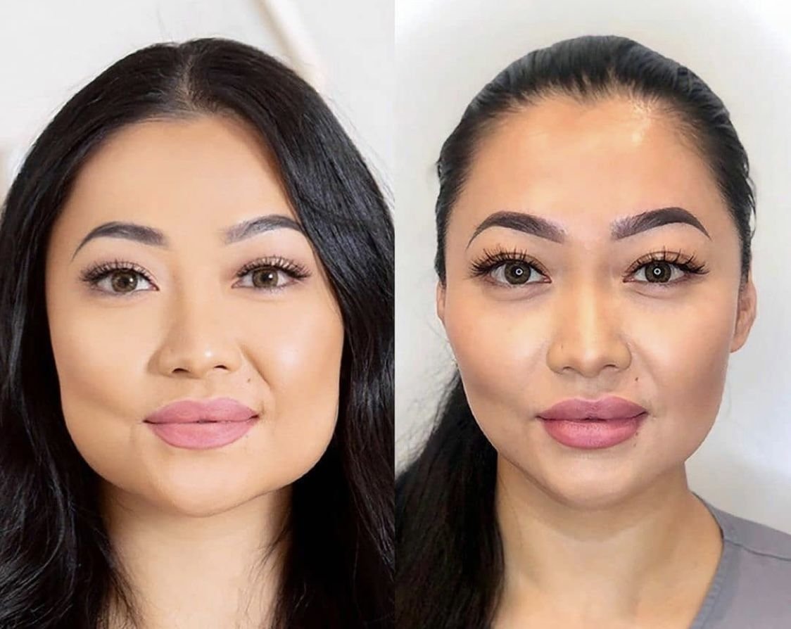 masseter botox vorher nachher