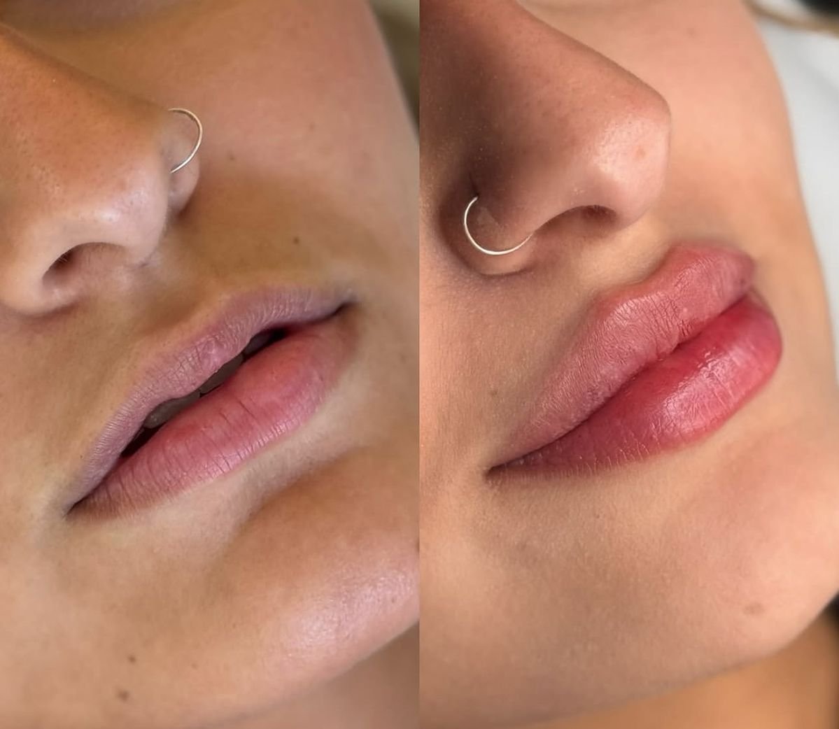 4ml lip filler before and after