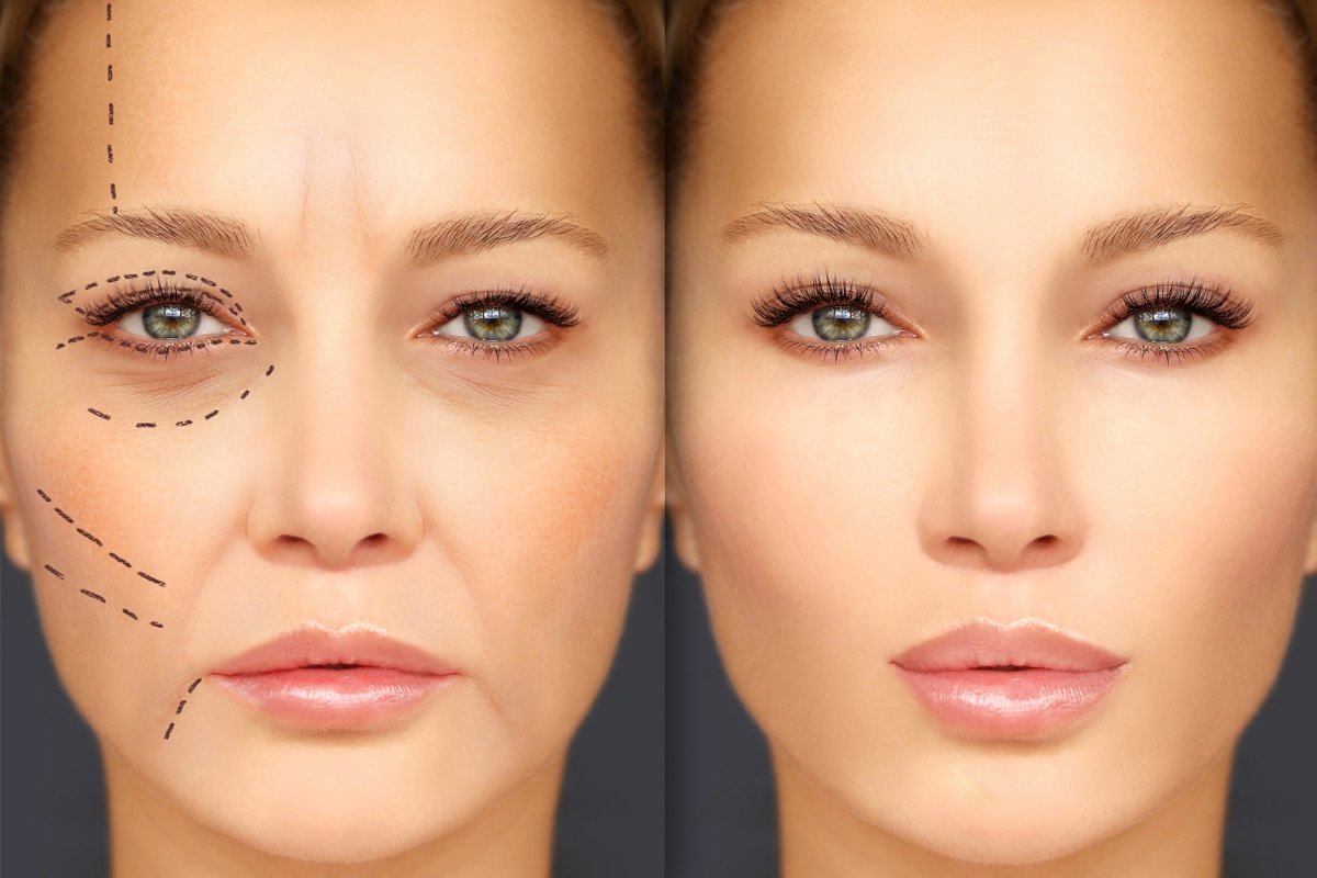 Dermal Fillers Leicester