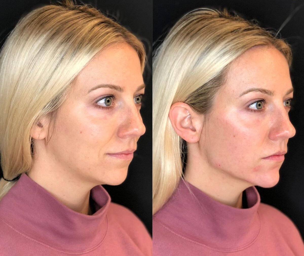 Woman with sharp, well-defined jawline after professional jawline filler treatment — before and after facial contouring results