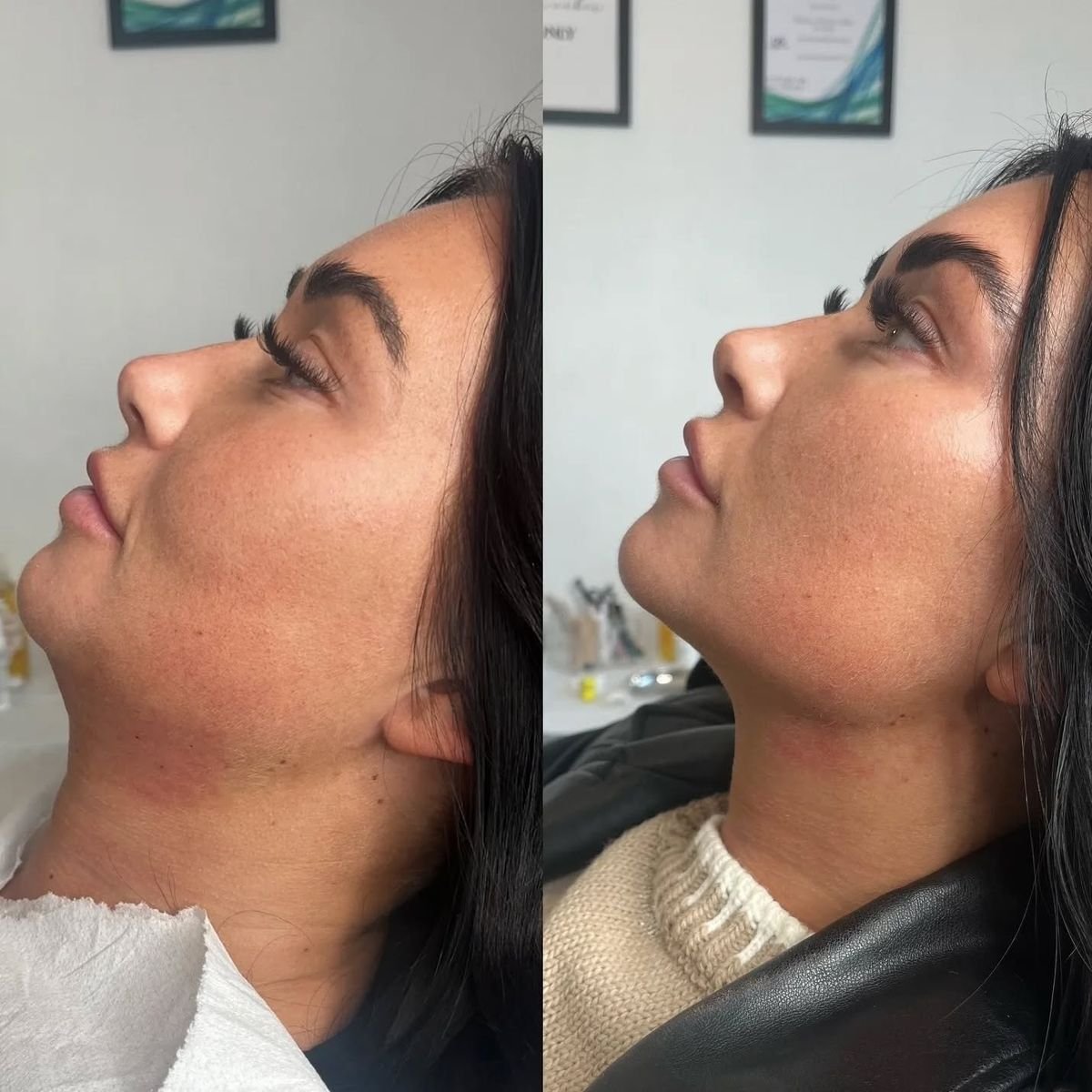cheek fillers cost