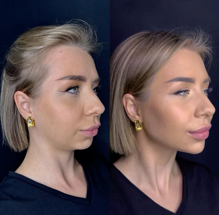 A woman receiving cheek fillers near me at a professional aesthetic injector services clinic for non-surgical cheek augmentation
