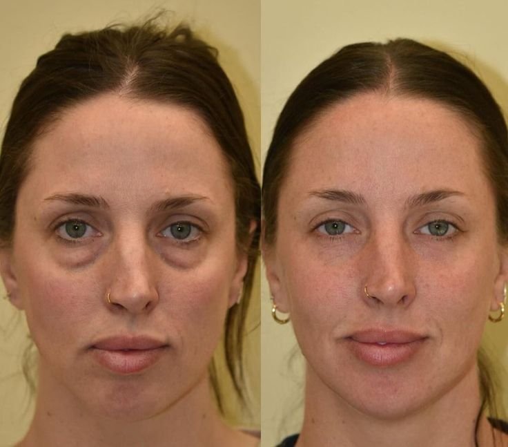 Buy Under Eye Filler Online