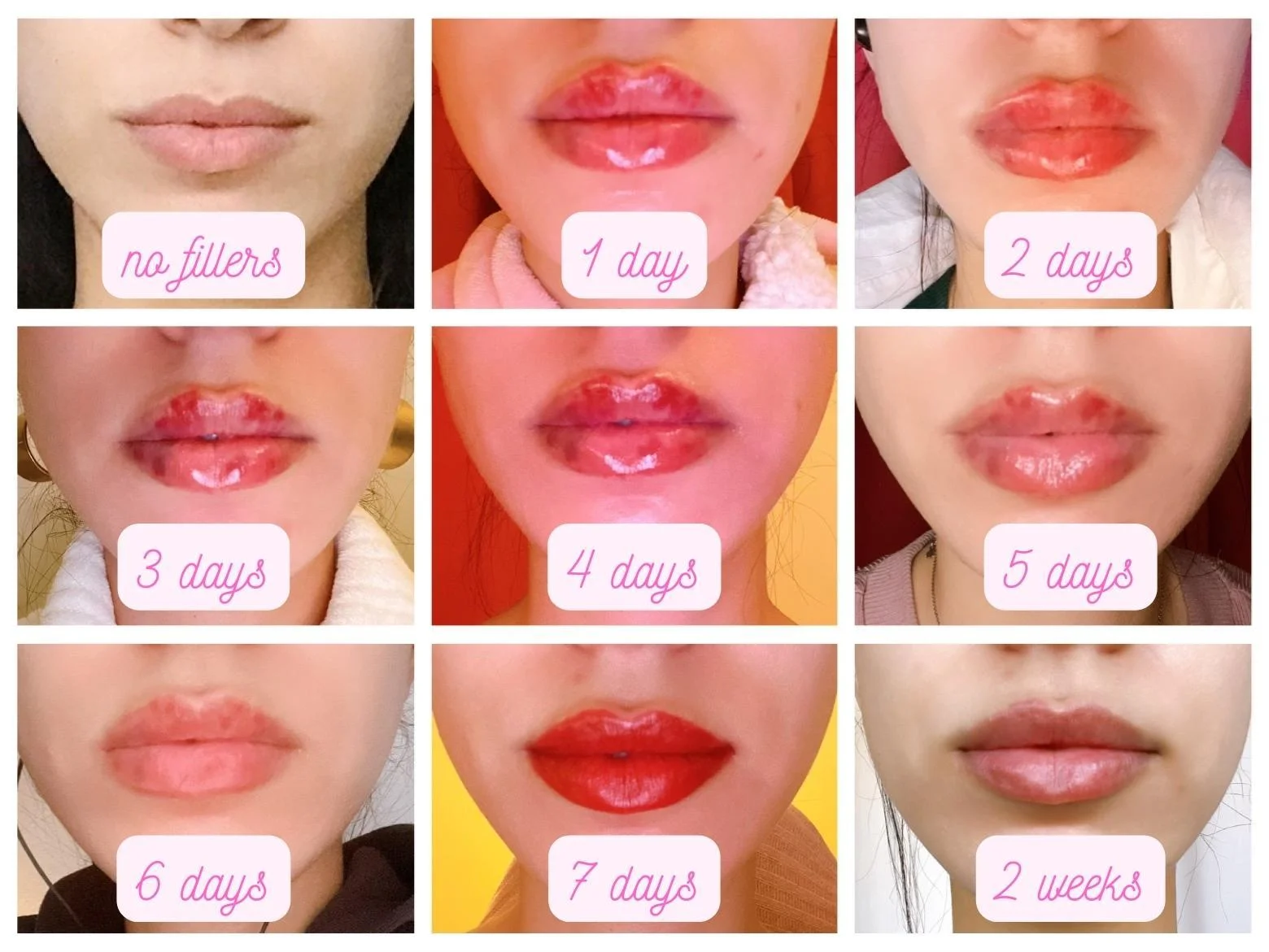 Close-up of natural, full lips showing lip filler swelling stages recovery timeline
