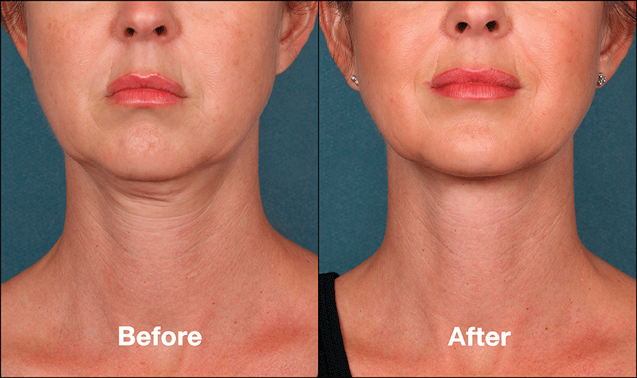 Hyperdilute Radiesse injectable treatment for advanced skin tightening and collagen stimulation