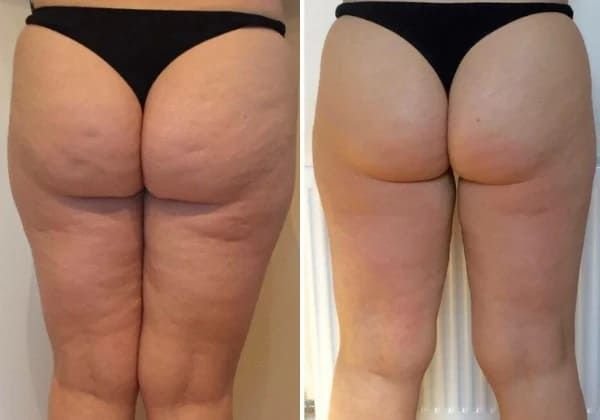 Sculptra before and after facial volume restoration results on a woman in her 40s