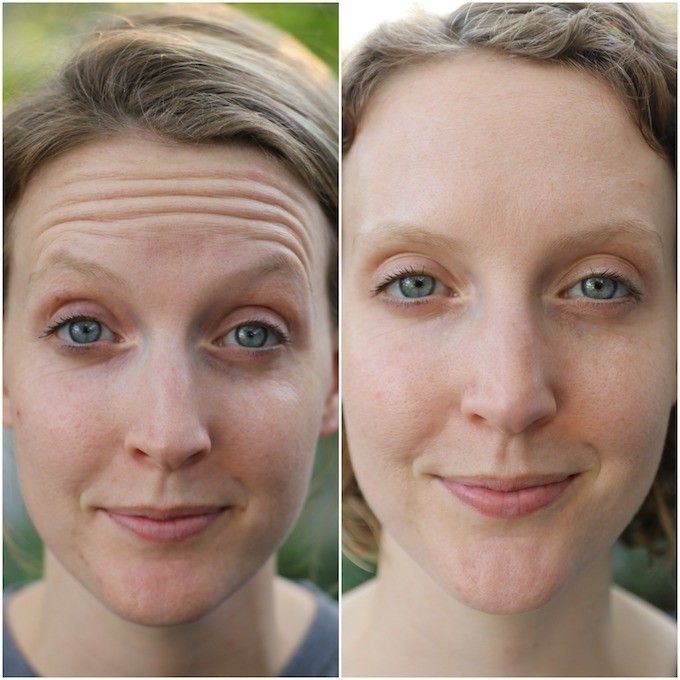 How Long Does Botox Last