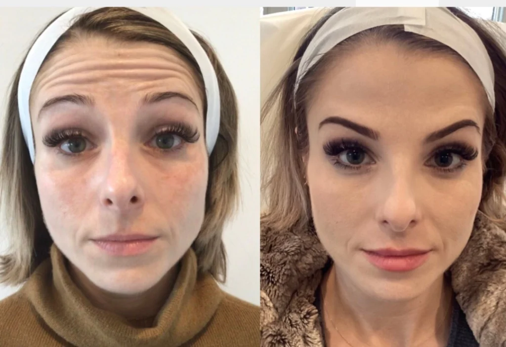 Before and after full face rejuvenation using premium face fillers from Filler Supply Store